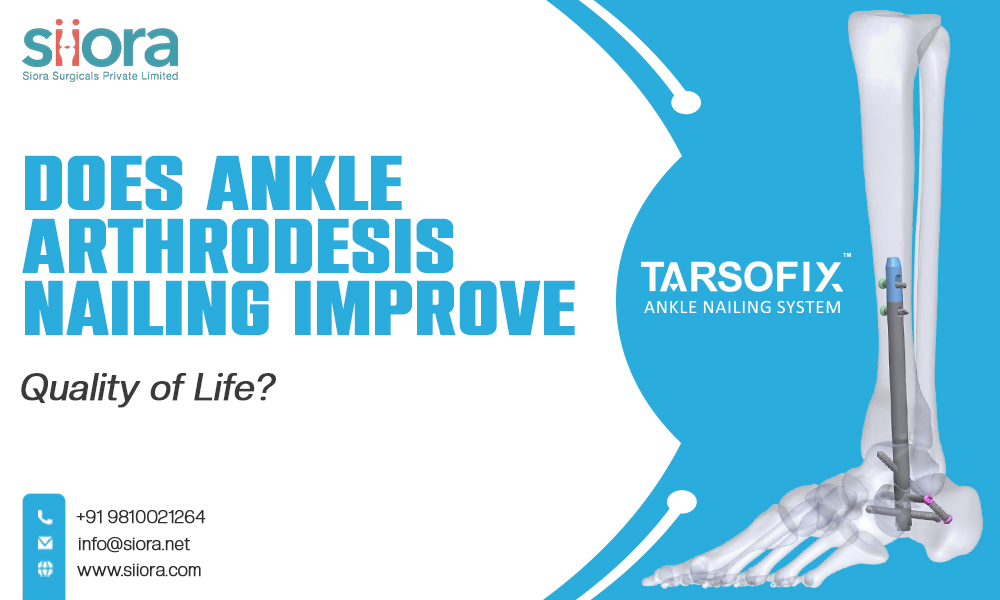 Ankle Arthrodesis Nailing