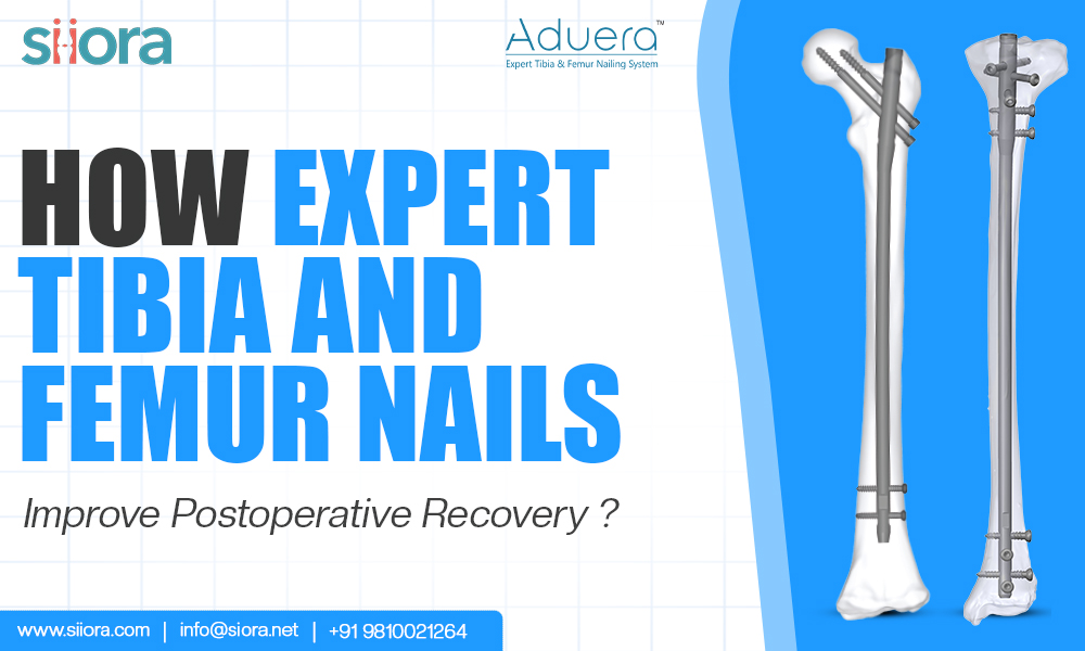 Expert Tibia and Femur Nails